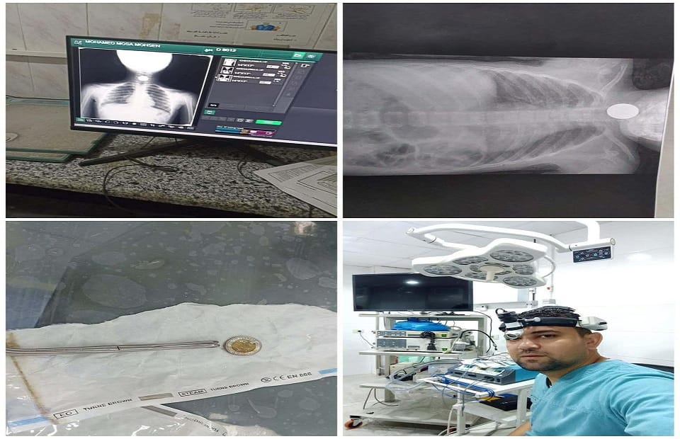 تدخل عاجل يُنقذ طفلين شقيقين من الاختناق بمستشفى السنبلاوين العام