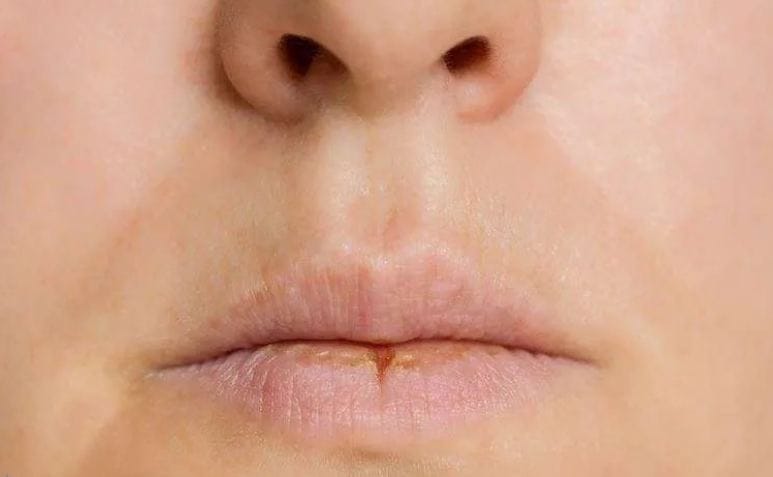 أسباب خفية لجفاف الفم قد تشير لمشكلات صحية